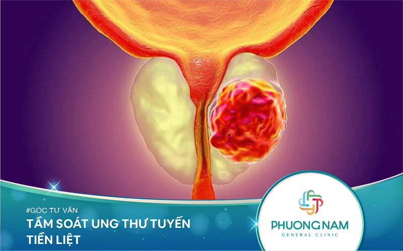 Tầm soát ung thư tiền liệt tuyến để phòng ngừa bệnh hiệu quả