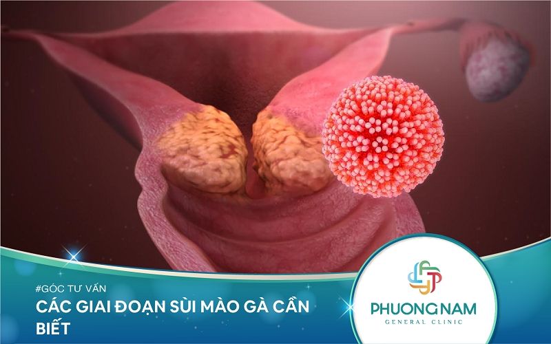 Các Giai Đoạn Sùi Mào Gà Cần Biết