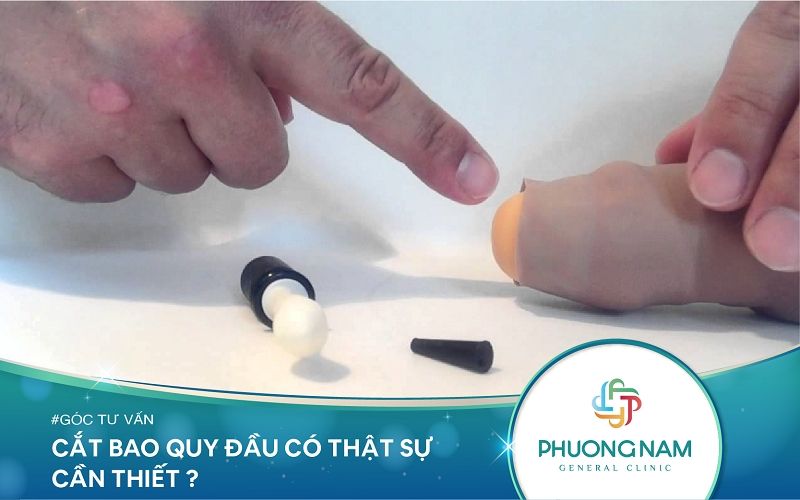 Cắt bao quy đầu là gì? Vì sao cần cắt bao quy đầu? Cắt bao quy đầu bao nhiêu tiền?