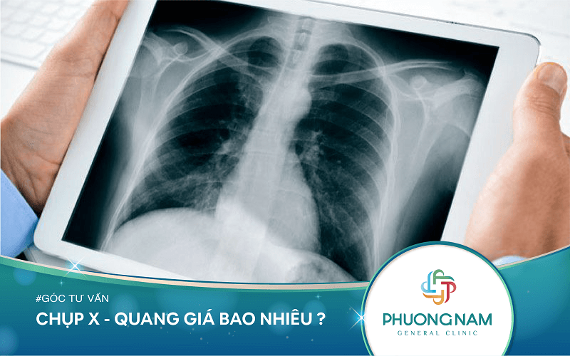 Chụp X – Quang Giá Bao Nhiêu? Các Yếu Tố Quyết Định