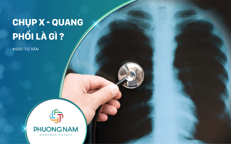 Chụp X – Quang Phổi Là Phương Pháp Gì?