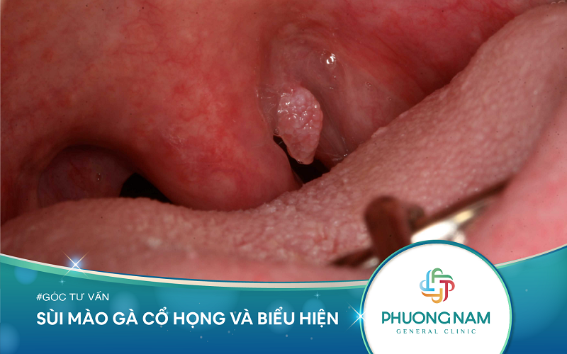 Sùi Mào Gà Cổ Họng Và Biểu Hiện
