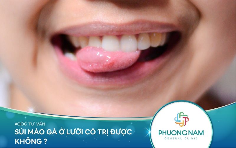 Sùi Mào Gà Ở Lưỡi – Những Điều Bạn Cần Biết