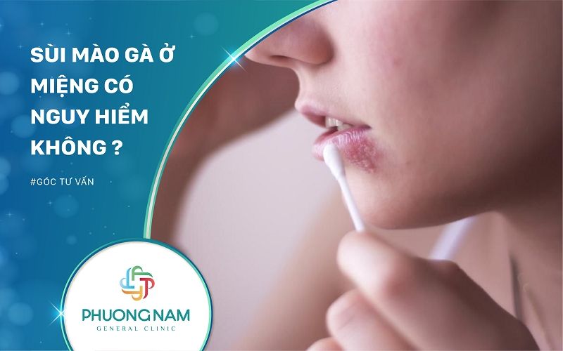 Sùi Mào Gà Ở Miệng Có Nguy Hiểm Không?