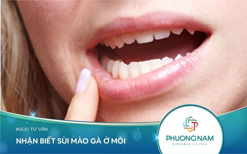 Nhận Biết Sùi Mào Gà Ở Môi Và Cách Trị Dứt Điểm