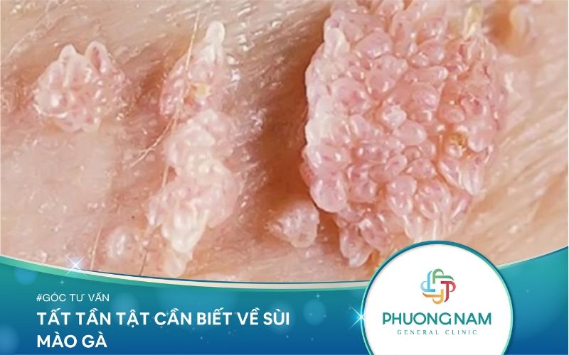 Tất Tần Tật Những Điều Cần Biết Về Sùi Mào Gà