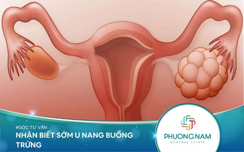 U Nang Buồng Trứng Ở Phụ Nữ – Đọc Ngay Để Nhận Biết Sớm Hơn