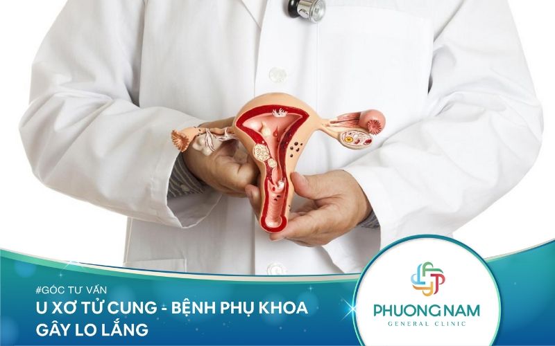U Xơ Tử Cung – Bệnh Phụ Khoa Khiến Phụ Nữ Lo Lắng