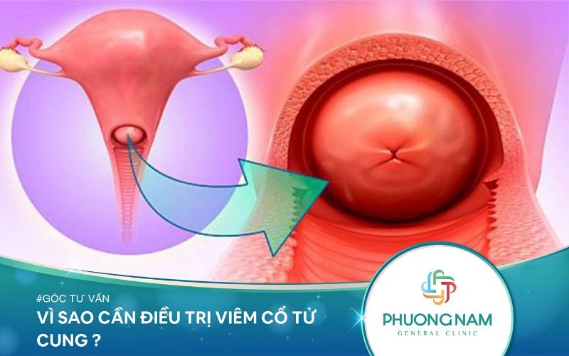 Vì Sao Cần Điều Trị Ngay Viêm Cổ Tử Cung?