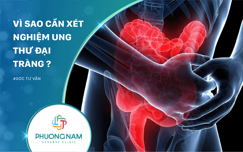 Vì Sao Cần Xét Nghiệm Ung Thư Đại Tràng?