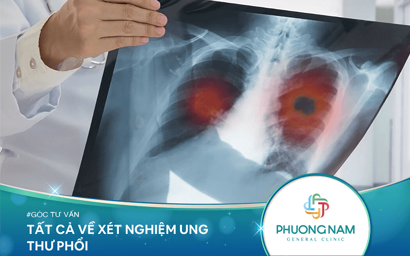 Tất Cả Về Xét Nghiệm Ung Thư Phổi Bạn Cần Biết