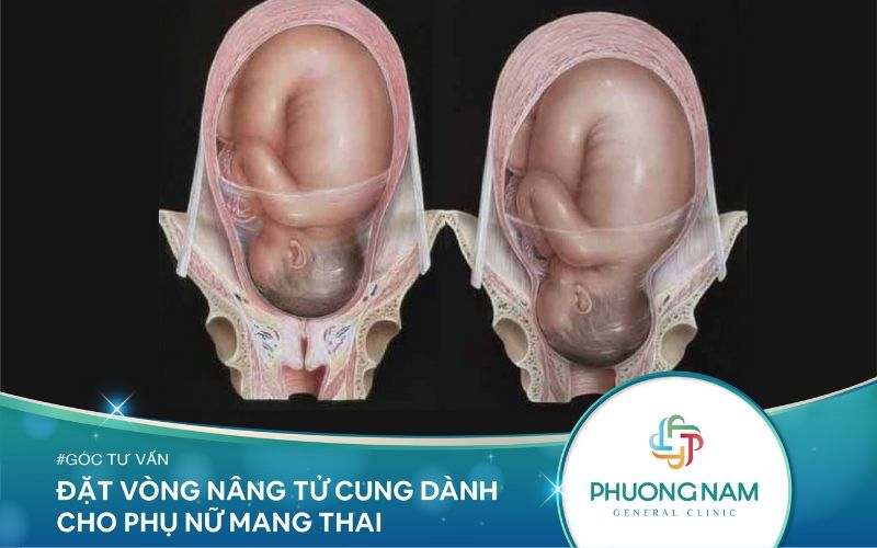 Đặt Vòng Nâng Tử Cung – Phương Pháp Dành Cho Phụ Nữ Mang Thai