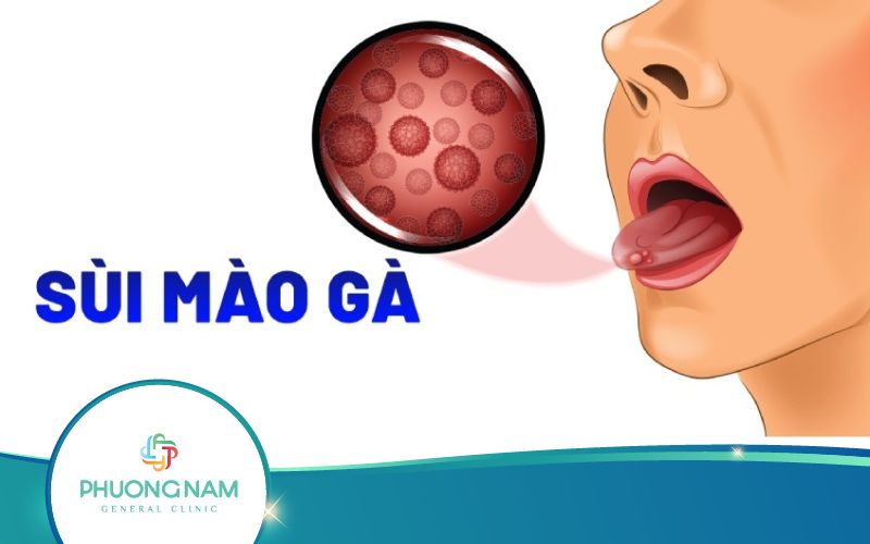 Chữa Sùi Mào Gà Ở Đà Lạt Tại Đâu Uy Tín?