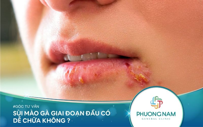 Sùi Mào Gà Nhẹ Ở Giai Đoạn Đầu Có Dễ Chữa Không?