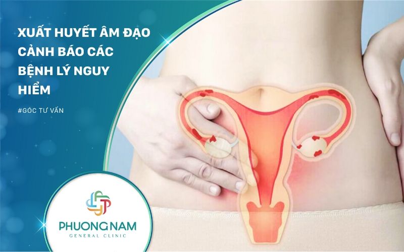 Xuất Huyết Âm Đạo – Cảnh Báo Các Bệnh Lý Nguy Hiểm