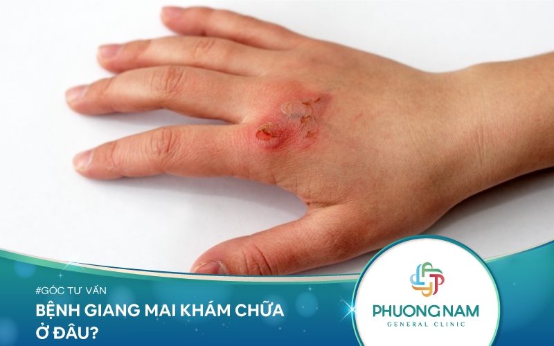 Bệnh Giang Mai Khám Chữa Ở Đâu?