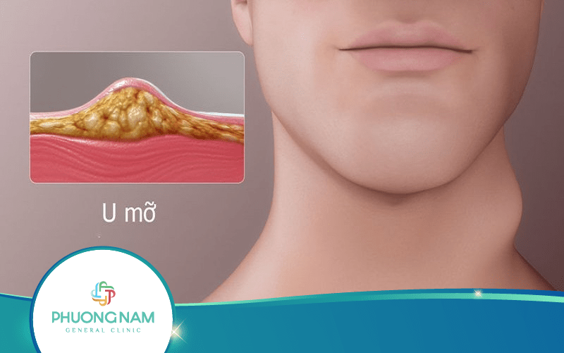 Khối U Mỡ Có Nguy Hiểm Không? Khi Nào Nên Siêu Âm U Mỡ?