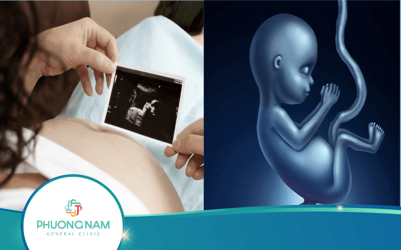 Mẹ Bầu Nên Siêu Âm Phát Hiện Dị Tật Ống Thần Kinh Khi Nào?