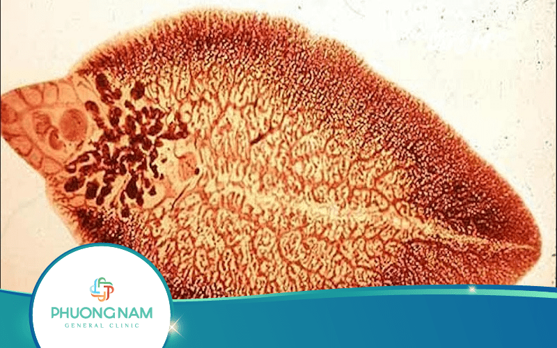 Siêu Âm Sán Lá Gan: Nguyên Nhân, Triệu chứng Và Cách Phòng Ngừa