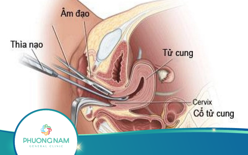 Độ Tuổi Cần Siêu Âm Phát Hiện Ung Thư Cổ Tử Cung