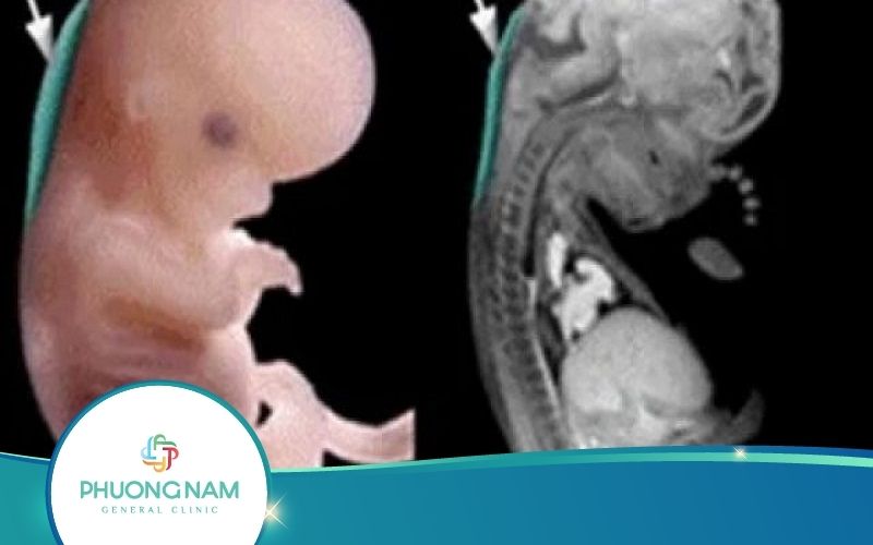 Siêu Âm Độ Mờ Da Gáy – Kiến Thức Thai Sản Dành Cho Mẹ Bầu