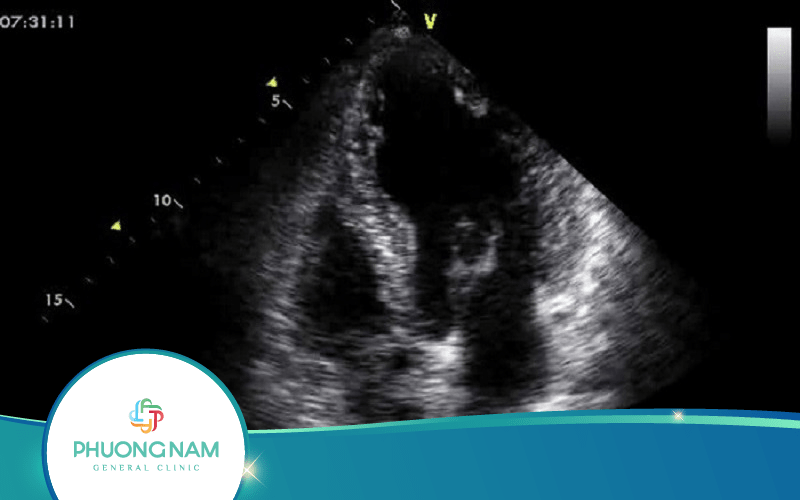 Siêu Âm Mạch Vành – 3 Triệu Chứng Cảnh Báo Bệnh Tim