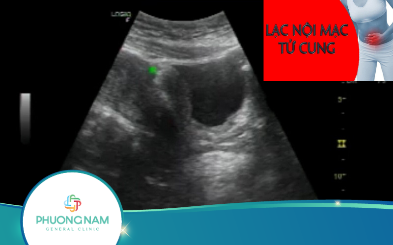 Siêu Âm Lạc Nội Mạc Tử Cung Chỗ Nào Tốt Nhất?