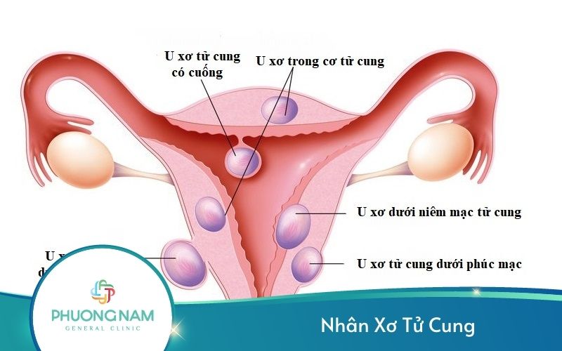 Nhân Xơ Tử Cung – Nguyên Nhân Và Cách Chữa Trị Hiệu Quả