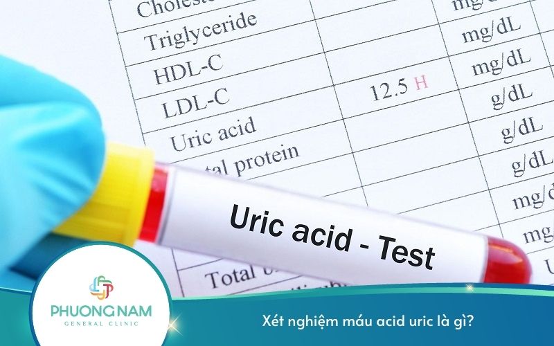 Xét Nghiệm Máu Acid Uric Là Gì?
