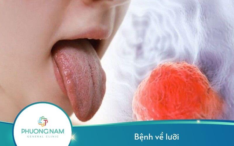 Các Bệnh Về Lưỡi Thường Gặp – [Chuyên Gia Giải Đáp]