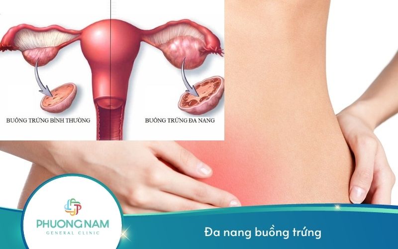 Đa Nang Buồng Trứng – Nguyên Nhân Gây Vô Sinh Hàng Đầu