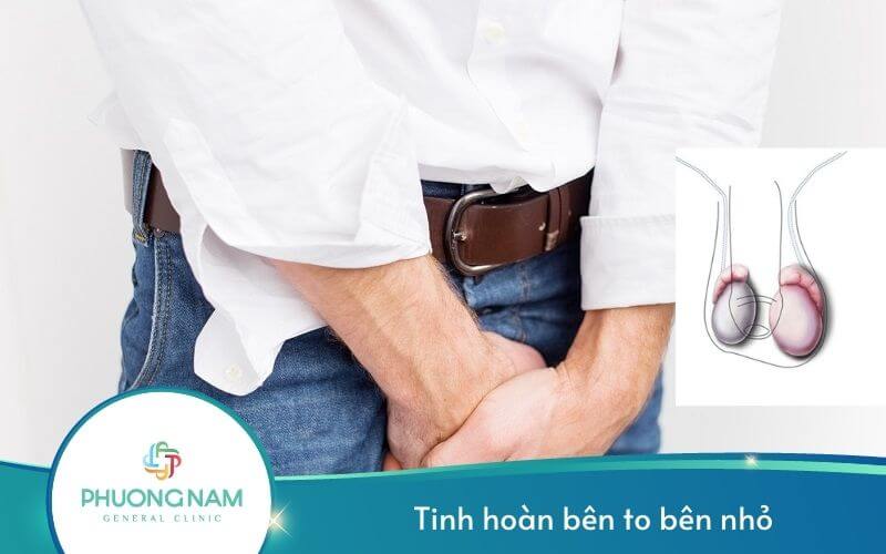 Tinh Hoàn Bên To Bên Nhỏ – Dấu Hiệu Của Bệnh Nam Khoa Nguy Hiểm