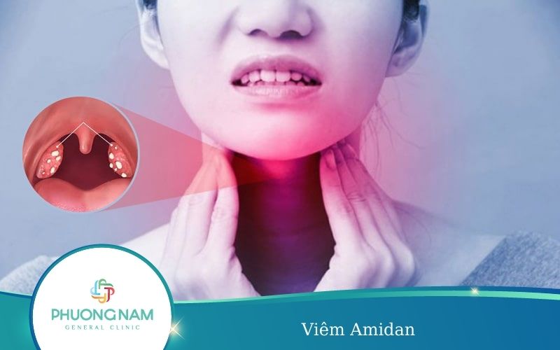 Viêm Amidan – Nguyên Nhân, Triệu Chứng, Cách Khắc Phục