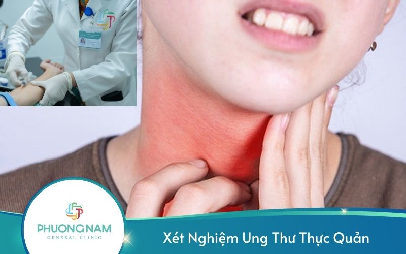 Xét Nghiệm Ung Thư Thực Quản – Đánh Giá Ung Thư Thực Quản Chuẩn Xác