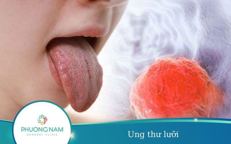 Ung Thư Lưỡi – Nguyên Nhân, Triệu Chứng, Cách Điều Trị
