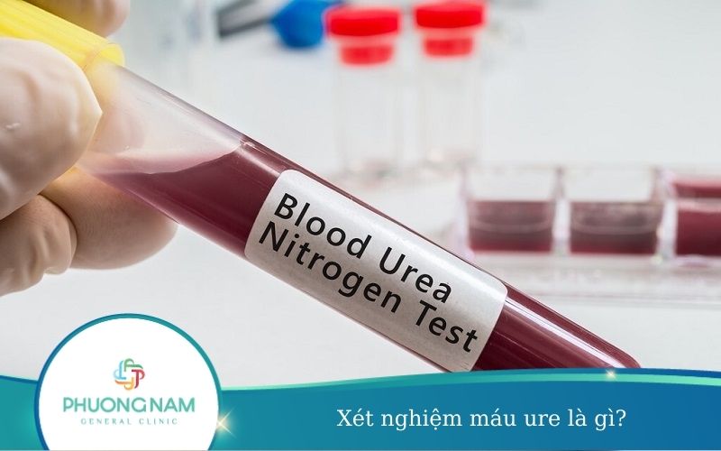 Xét Nghiệm Máu Ure Là Gì? – Bác Sĩ Giải Đáp