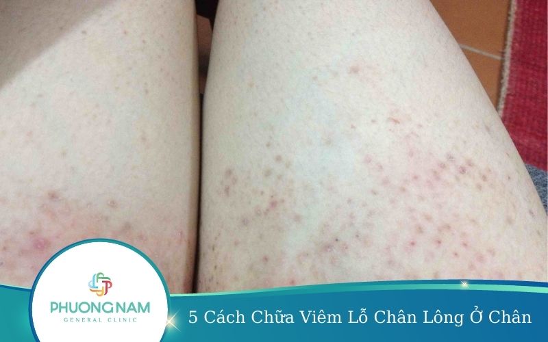 5 Cách Chữa Viêm Lỗ Chân Lông Ở Chân Siêu Hiệu Quả