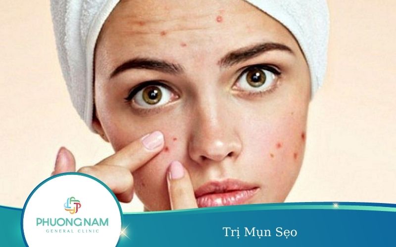 Trị Mụn Sẹo – Tất Tần Tật Thông Tin Cần Biết