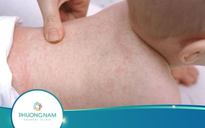 Bé Bị Nổi Mẩn Đỏ Khắp Người Và Ngứa Làm Sao Khắc Phục?