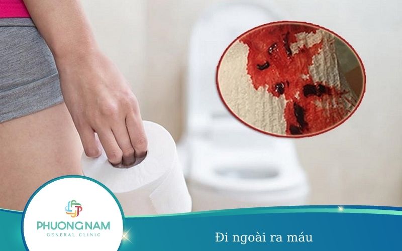 Đi Ngoài Ra Máu – Triệu Chứng Không Nên Coi Thường