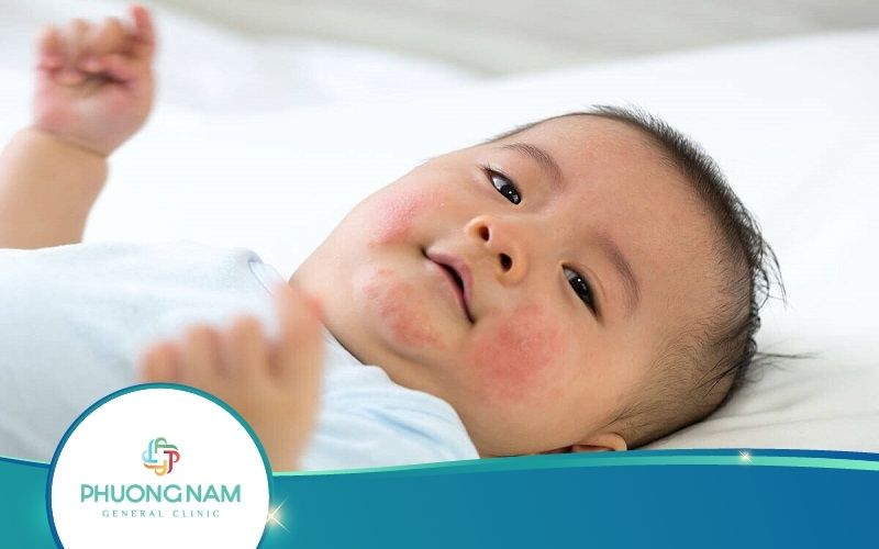 Mẹ Cần Lưu Ý Gì Khi Bé Sơ Sinh Bị Nổi Mẩn Đỏ Ở Mặt?