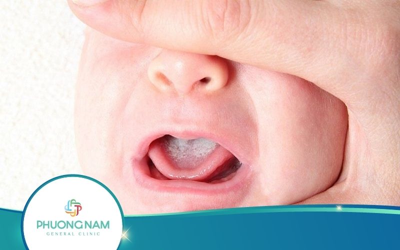 Bệnh Nấm Miệng Ở Trẻ Sơ Sinh Nguy Hiểm Không? Trị Thế Nào?