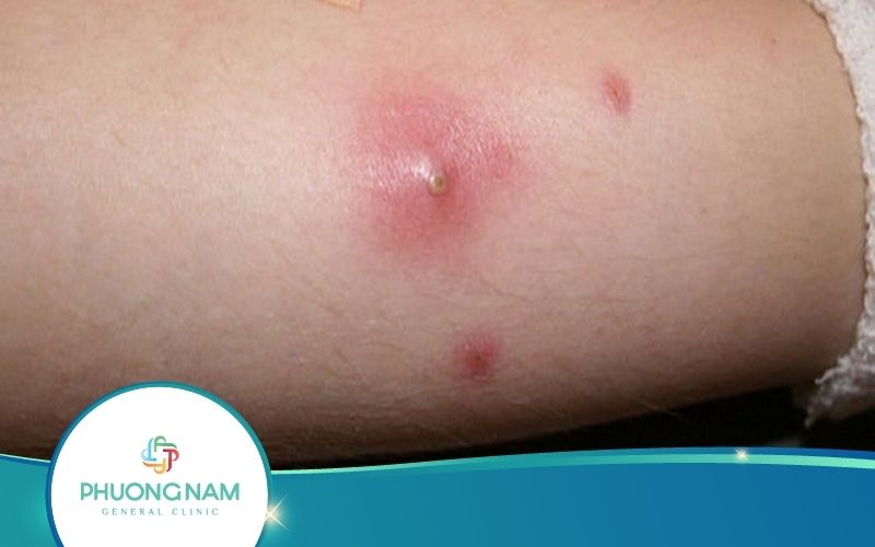 Bị mụn nhọt kiêng ăn gì, và nên ăn gì?
