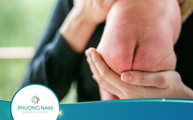 Top 8 Cách Chữa Hăm Cho Trẻ Sơ Sinh Hiệu Quả Tại Nhà