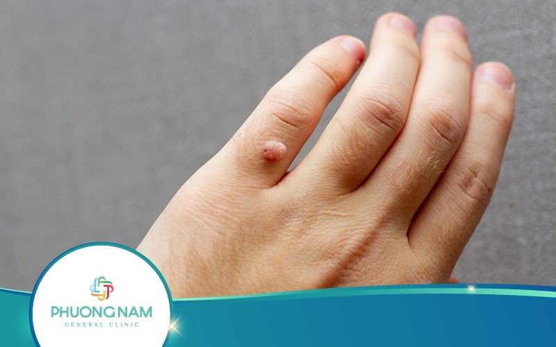 Top 10 Cách Trị Mụn Cóc Ở Tay Dân Gian Đơn Giản Và Hiệu Quả