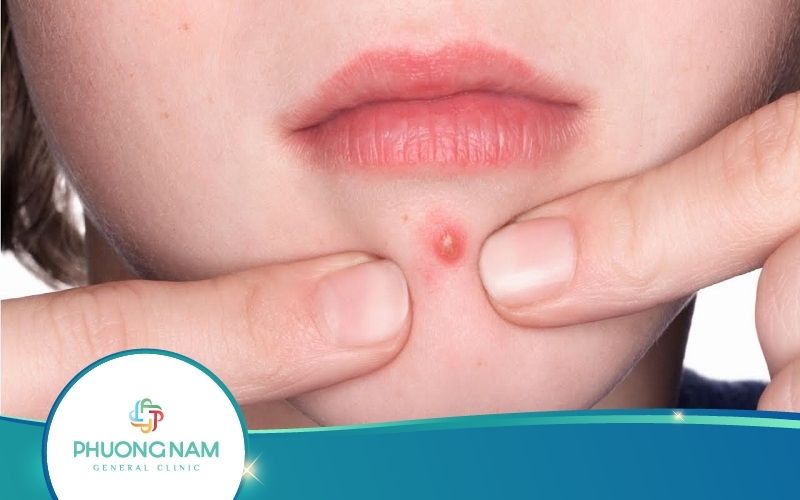 [Nhất Định Phải Biết] Đắp Lá Gì Để Hút Mủ Khi Bị Mụn Nhọt?