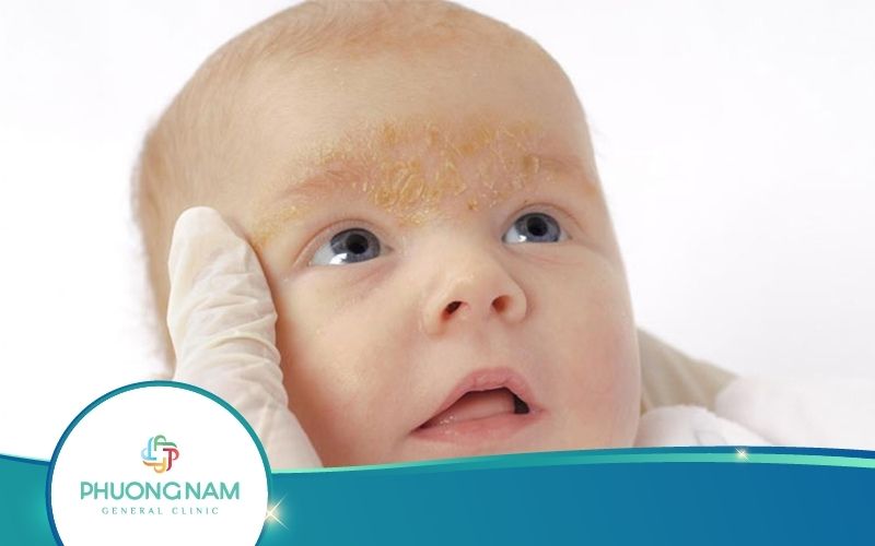 Hỏi Đáp: Vì Sao Lông Mày Trẻ Sơ Sinh Có Vảy?
