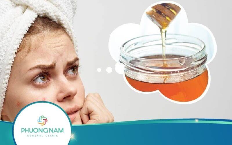 Nặn Mụn Xong Có Nên Bôi Mật Ong Không?