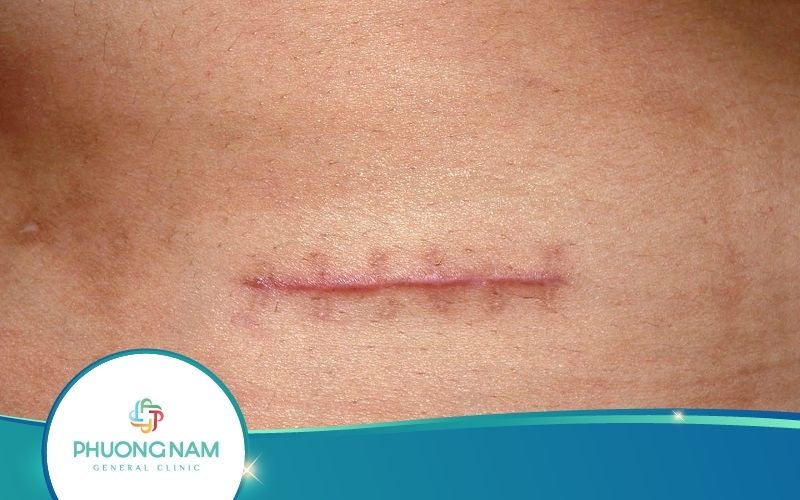 [Giải Đáp] Thời Gian Ăn Kiêng Chống Sẹo Lồi, Sẹo Thâm Là Bao Lâu?