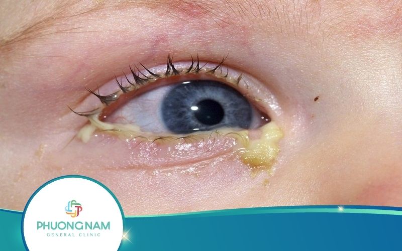 4 Điều Mẹ Cần Biết Khi Trẻ Sơ Sinh Bị Ghèn Mắt